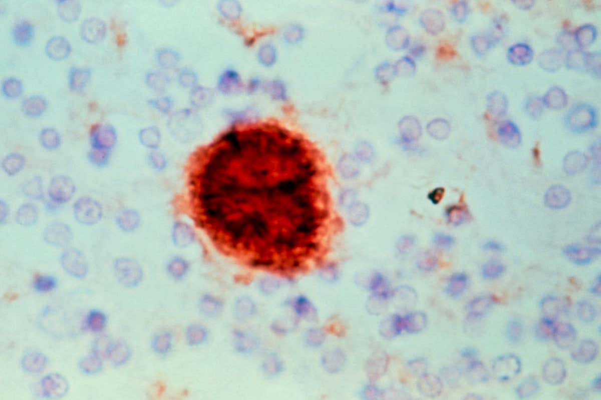 A brown plaque formed in a human brain produced by the virus-like prion that causes Creutzfeldt-Jakob disease